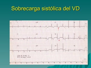 Sobrecarga sistólica del VD 