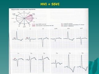 HVI + SSVI 