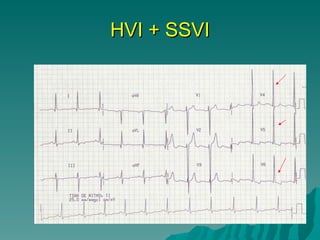 HVI + SSVI 