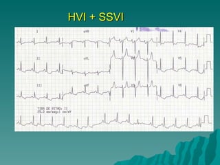 HVI + SSVI 