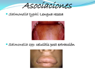 Asociaciones
 Salmonella typhi: Lengua reseca




 Salmonella spp: celulitis post extracción
 