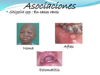 
            Asociaciones
    Shigella spp : En casos raros




          Noma                 Aftas




                 Estomatitis
 