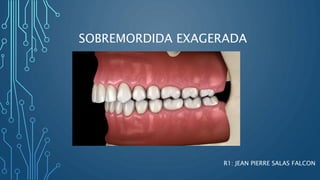 SOBREMORDIDA EXAGERADA
R1: JEAN PIERRE SALAS FALCON
 