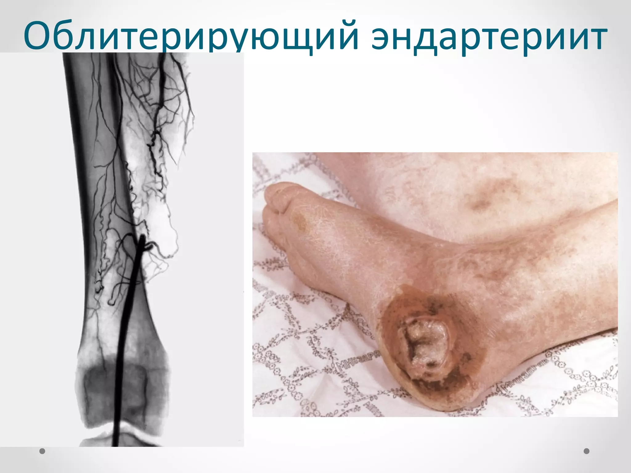 Облитерирующий эндартериит
 