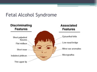 Fetal Alcohol Syndrome
 