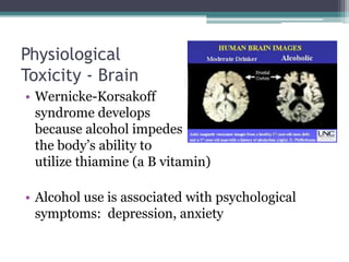Physiological
Toxicity - Brain
• Wernicke-Korsakoff
syndrome develops
because alcohol impedes
the body’s ability to
utilize thiamine (a B vitamin)
• Alcohol use is associated with psychological
symptoms: depression, anxiety
 