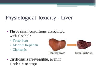 Physiological Toxicity - Liver
• Three main conditions associated
with alcohol:
▫ Fatty liver
▫ Alcohol hepatitis
▫ Cirrhosis
• Cirrhosis is irreversible, even if
alcohol use stops
 