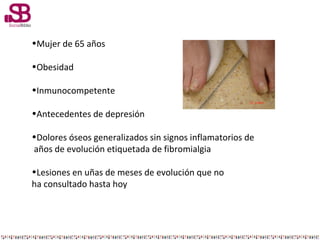 •Mujer de 65 años
•Obesidad
•Inmunocompetente
•Antecedentes de depresión
•Dolores óseos generalizados sin signos inflamato...