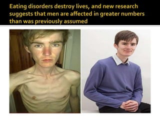 Eating disorders destroy lives, and new research suggests that men are affected in greater numbers than was previously assumed