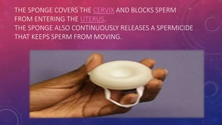 THE SPONGE COVERS THE CERVIX AND BLOCKS SPERM
FROM ENTERING THE UTERUS.
THE SPONGE ALSO CONTINUOUSLY RELEASES A SPERMICIDE
THAT KEEPS SPERM FROM MOVING.
 