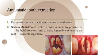 Comprehensive Guide to Socket Preservation After Tooth Extraction | PPTX