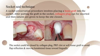 Comprehensive Guide to Socket Preservation After Tooth Extraction | PPTX