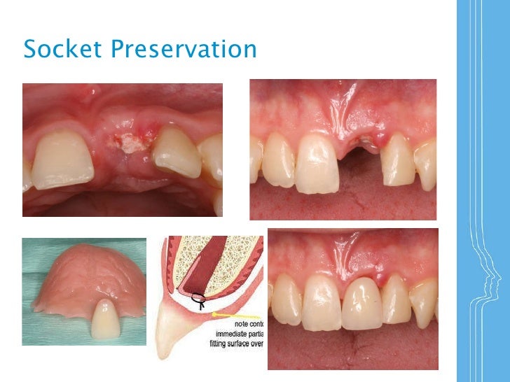 Socket Preservation _NIDM January 2011
