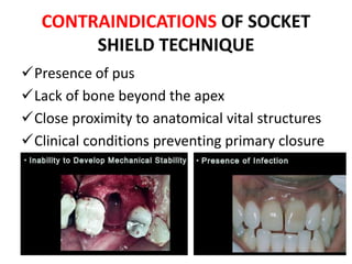CONTRAINDICATIONS OF SOCKET
SHIELD TECHNIQUE
Presence of pus
Lack of bone beyond the apex
Close proximity to anatomical vital structures
Clinical conditions preventing primary closure
 