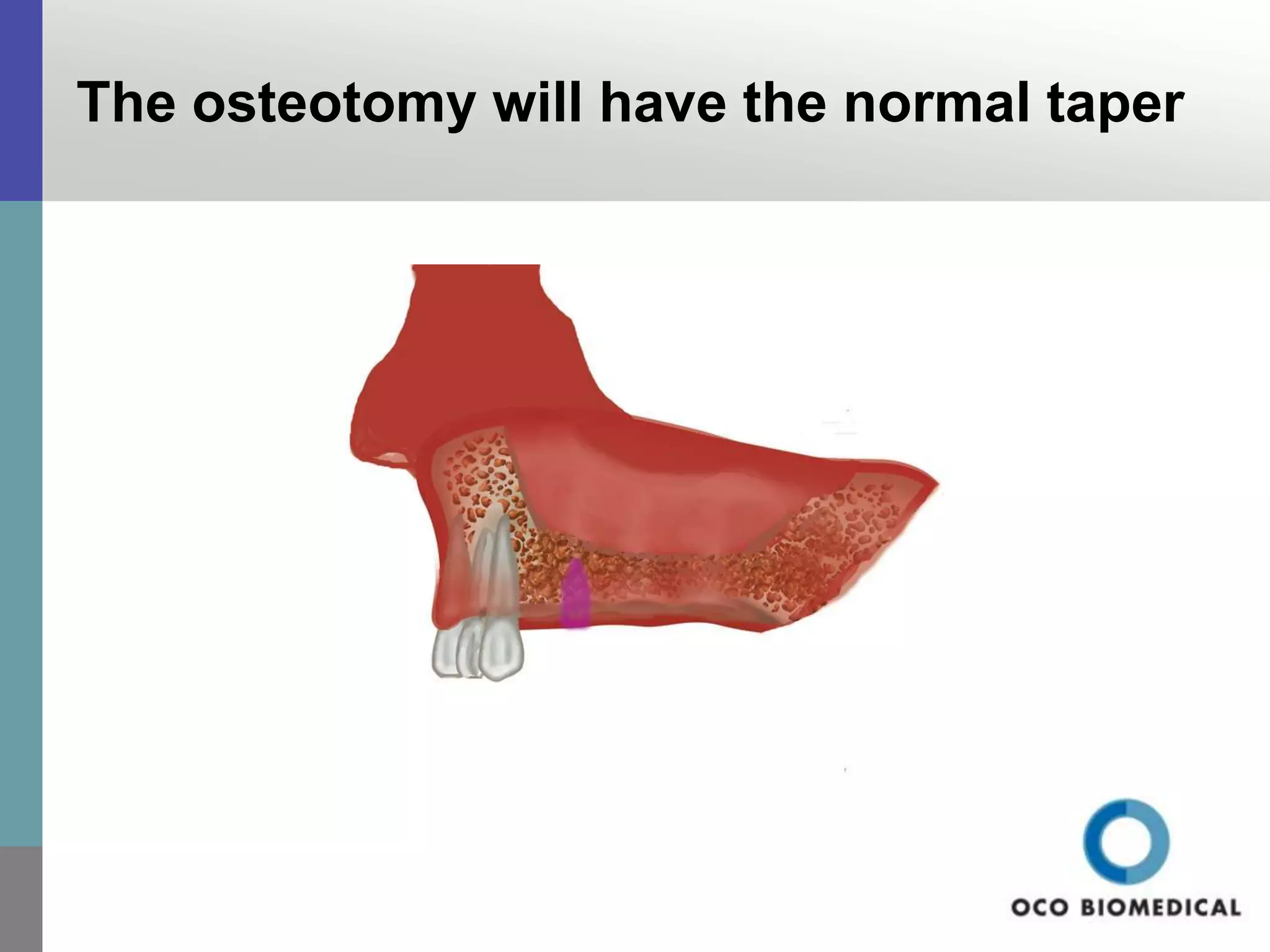 Socket sinus lift | PPTX