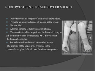 NORTHWESTERN SUPRACONDYLER SOCKET
 Accommodate all lengths of transradial amputations.
 Provide an improved range of motion at the elbow.
 Narrow M-L
 Anterior trimline is below antecubital area,
 The anterior trimline, superior to the humeral condyles, should be at least
3/8 inch smaller than the measured M-L dimension at
the humeral condyles.
 Posterior trimlines be well rounded to accept
The contour of the upper arm, proximal to the
Humeral condyles. 1/2inch over the olecrenon process
 