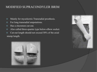 MODIFIED SUPRACONDYLER BRIM
 Mainly for myoelectric Transradial prosthesis.
 For long transradial amputations.
 Has a olecrenon cut-out.
 Also called three-quarter type below-elbow socket.
 Cut-out length should not exceed 50% of the axial
stump length.
 