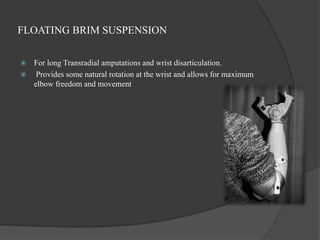 FLOATING BRIM SUSPENSION
 For long Transradial amputations and wrist disarticulation.
 Provides some natural rotation at the wrist and allows for maximum
elbow freedom and movement
 