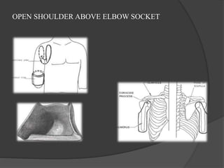 OPEN SHOULDER ABOVE ELBOW SOCKET
 