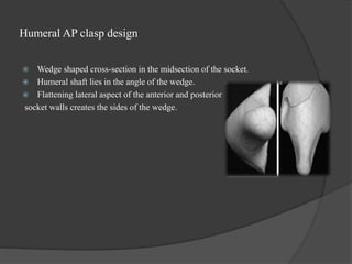 Humeral AP clasp design
 Wedge shaped cross-section in the midsection of the socket.
 Humeral shaft lies in the angle of the wedge.
 Flattening lateral aspect of the anterior and posterior
socket walls creates the sides of the wedge.
 