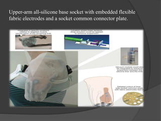 Upper-arm all-silicone base socket with embedded flexible
fabric electrodes and a socket common connector plate.
 
