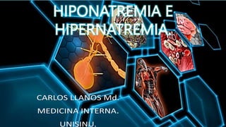 HIPONATREMIA E
HIPERNATREMIA.
 