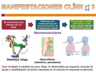 Potasio endovenoso (“retos de potasio”):
• No mas de 20mEq/h (40mEq/h en casos graves).
• No mas de 150mEq/24h.
• No usar soluciones glucosadas.
• Control sérico y de EKG al final de cada reto.
Hipokalemia
Solo en déficit grave y por
vía central.
 