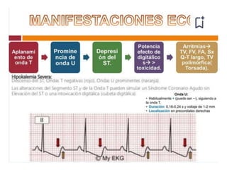 Manifestaciones Clínicas:
• Cardiacas, neuromusculares y gastrointestinales.
• Enlentecimiento de la conducción cardíaca:
– Ondas T picudas.
– Onda P aplanada.
– Intervalo PR largo.
– Prolongación del QRS.
– Asistolia ventricular.
Hiperkalemia
 