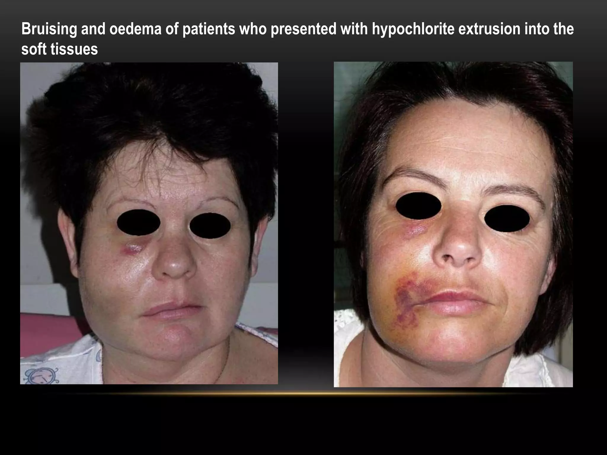 Bruising and oedema of patients who presented with hypochlorite extrusion into the
soft tissues
 