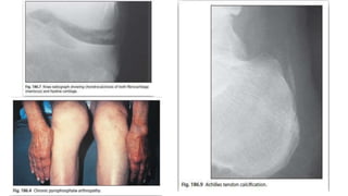 Gout Racgp Gout | PPTX