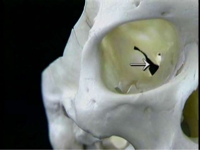 superior orbital fissure syndrome superior orbital fissure