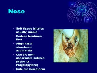 Nose Soft tissue injuries usually simple Reduce fractures first Align nasal structures accurately Use 6-0 non-absorbable sutures (Nylon or Polypropylene) Rule out hematoma 