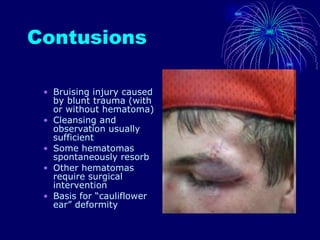 Contusions Bruising injury caused by blunt trauma (with or without hematoma) Cleansing and observation usually sufficient Some hematomas spontaneously resorb Other hematomas require surgical intervention Basis for “cauliflower ear” deformity 