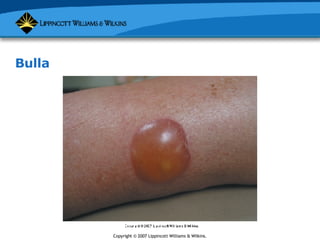 Soft Tissue Lesions | PPT