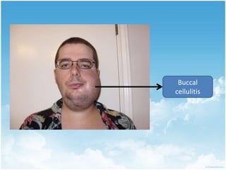 Intensity of pain depends acute , spreading, distensions of tissue