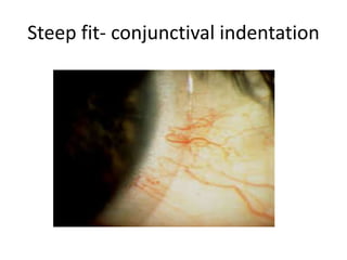 Steep fit- conjunctival indentation
 