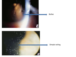 Soft contact lens complications | PPTX