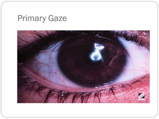 Primary Gaze
 