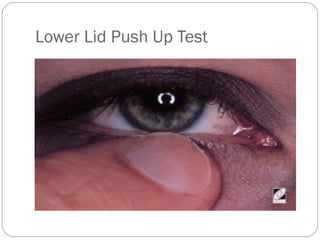 Lower Lid Push Up Test
 