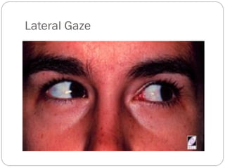 Lateral Gaze
 