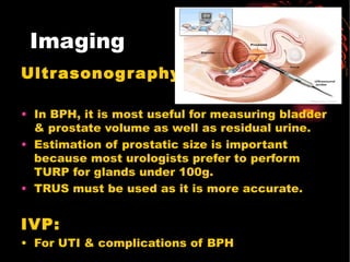 Imaging <ul><li>Ultrasonography: </li></ul><ul><li>In BPH, it is most useful for measuring bladder & prostate volume as we...