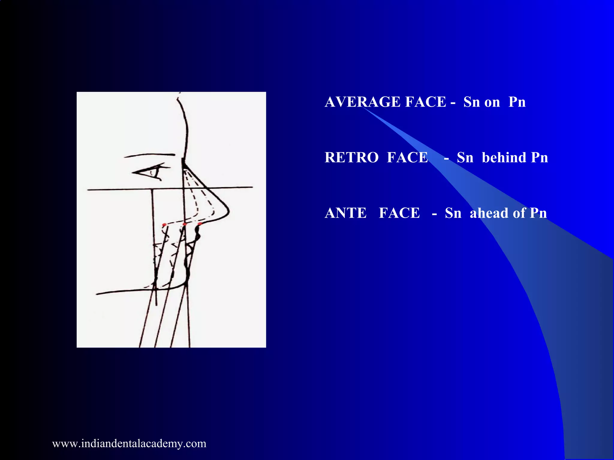 AVERAGE FACE - Sn on Pn
RETRO FACE - Sn behind Pn
ANTE FACE - Sn ahead of Pn
www.indiandentalacademy.com
 