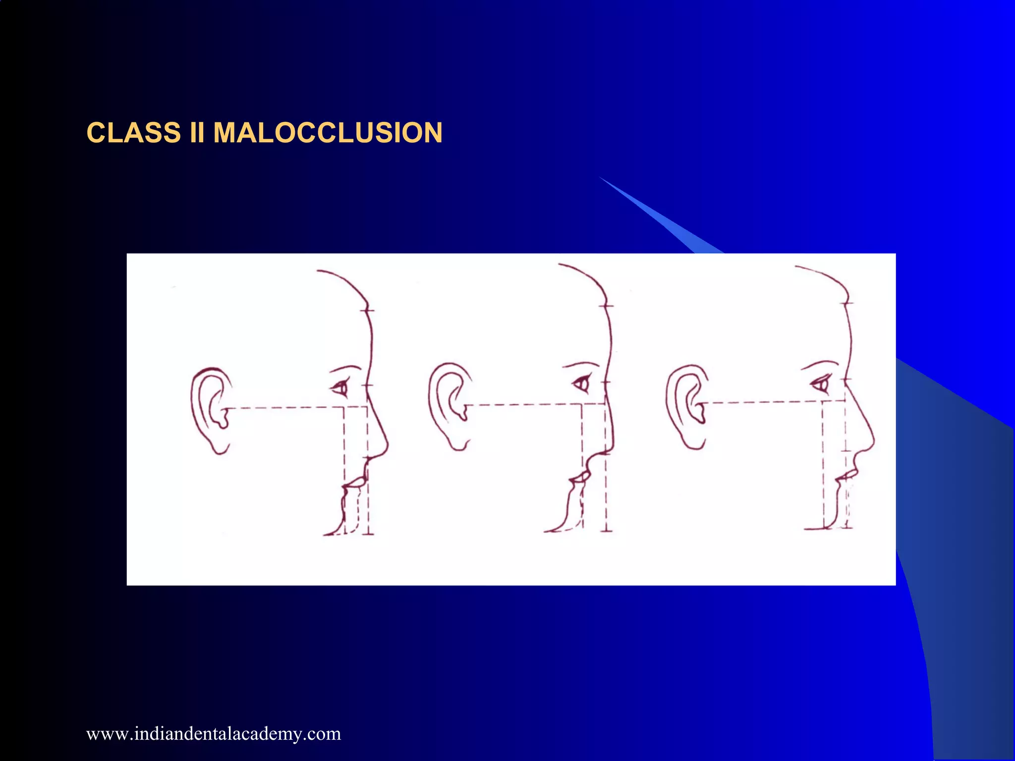 CLASS II MALOCCLUSION
www.indiandentalacademy.com
 