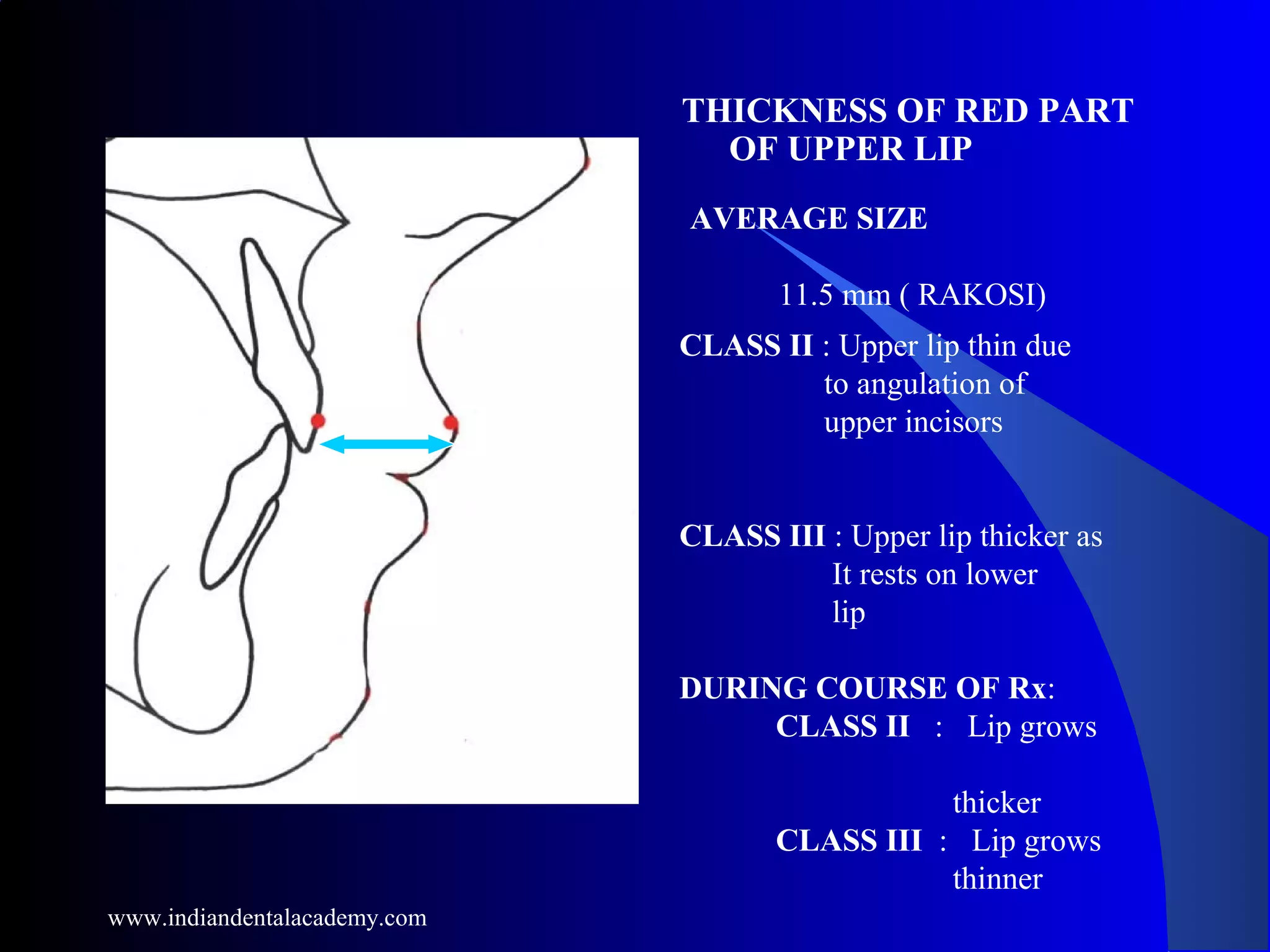 THICKNESS OF RED PART
OF UPPER LIP
AVERAGE SIZE
11.5 mm ( RAKOSI)
CLASS II : Upper lip thin due
to angulation of
upper incisors
CLASS III : Upper lip thicker as
It rests on lower
lip
DURING COURSE OF Rx:
CLASS II : Lip grows
thicker
CLASS III : Lip grows
thinner
www.indiandentalacademy.com
 