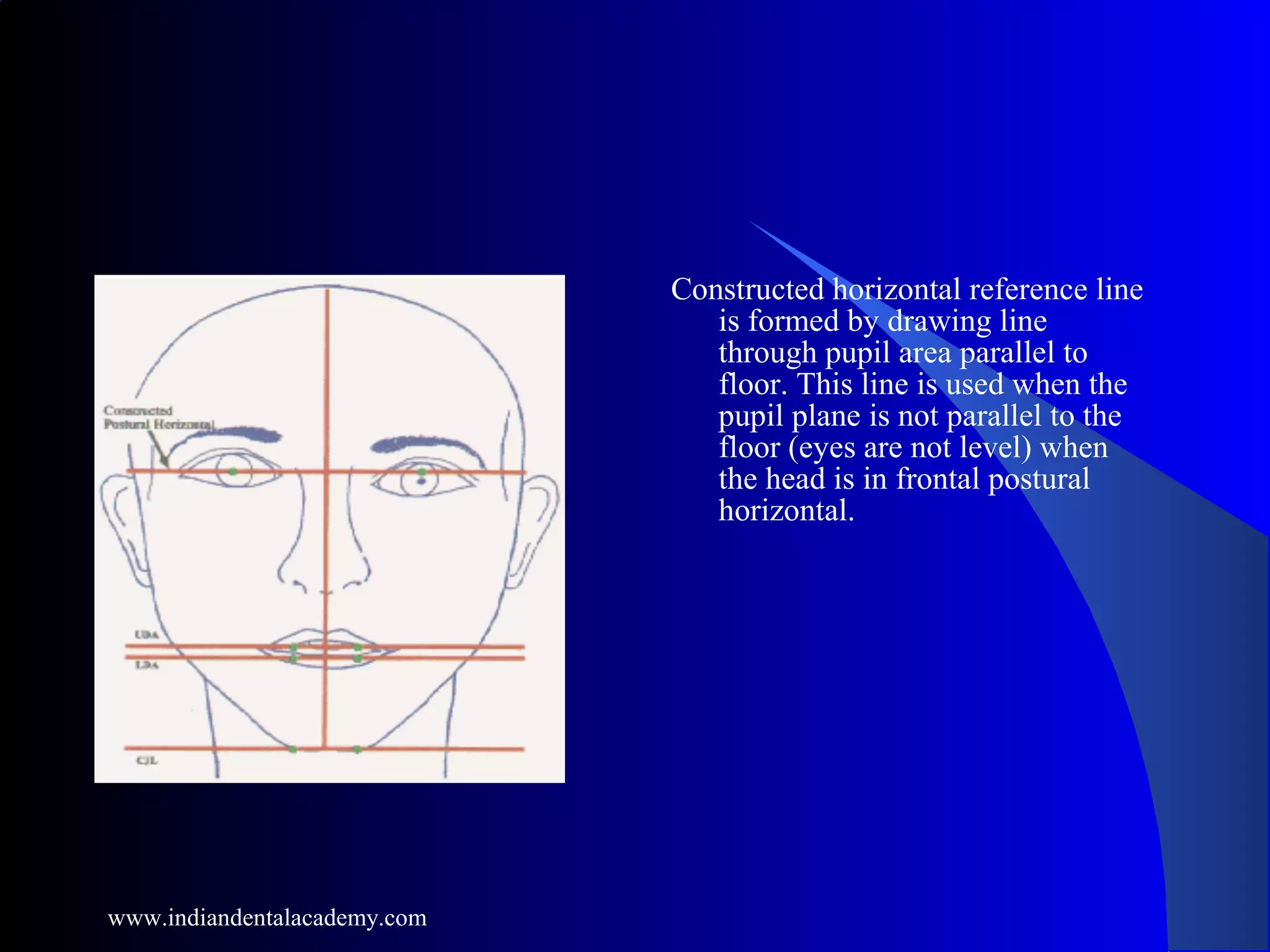 Constructed horizontal reference line
is formed by drawing line
through pupil area parallel to
floor. This line is used when the
pupil plane is not parallel to the
floor (eyes are not level) when
the head is in frontal postural
horizontal.
www.indiandentalacademy.com
 