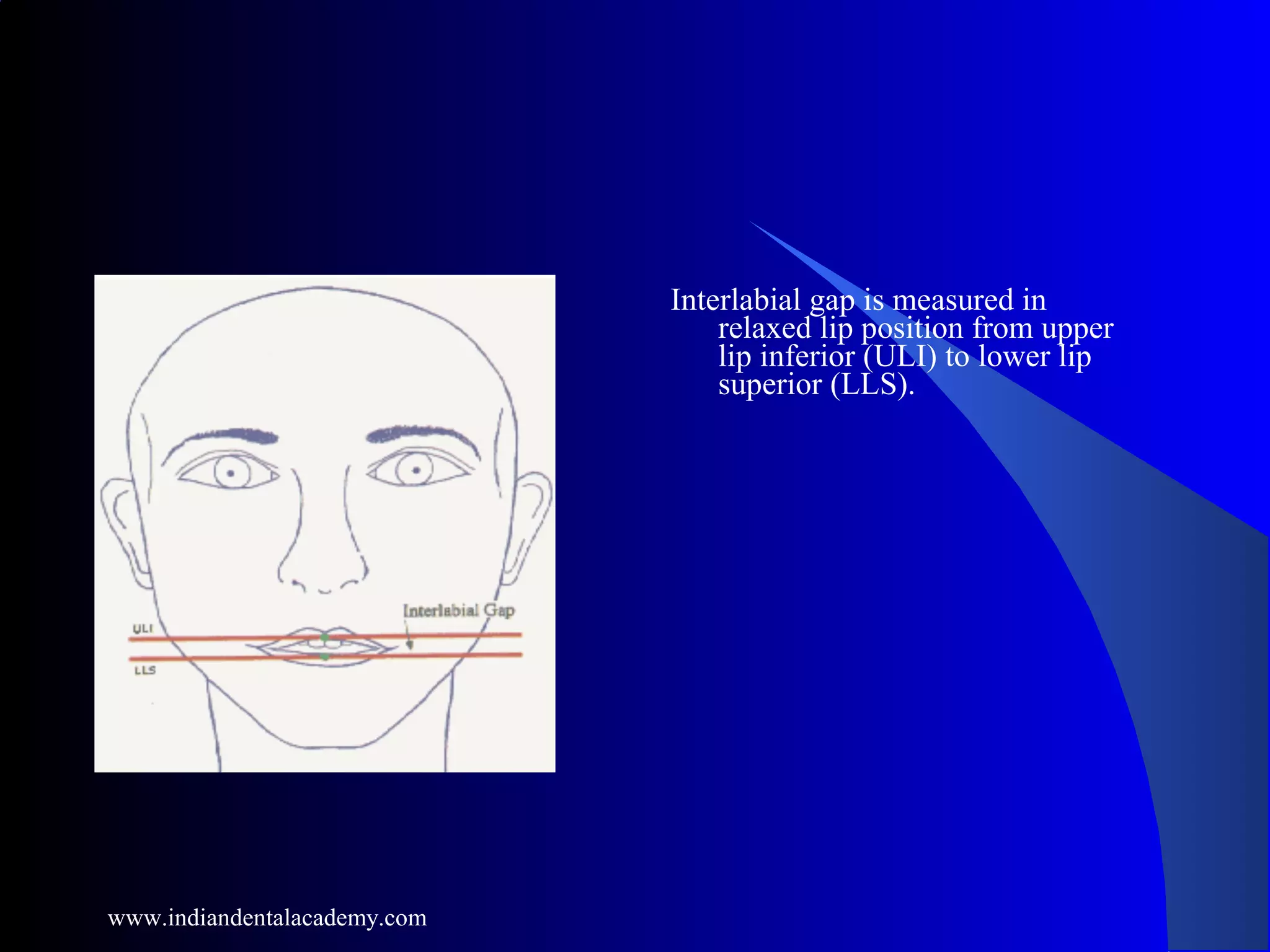 Interlabial gap is measured in
relaxed lip position from upper
lip inferior (ULI) to lower lip
superior (LLS).
www.indiandentalacademy.com
 