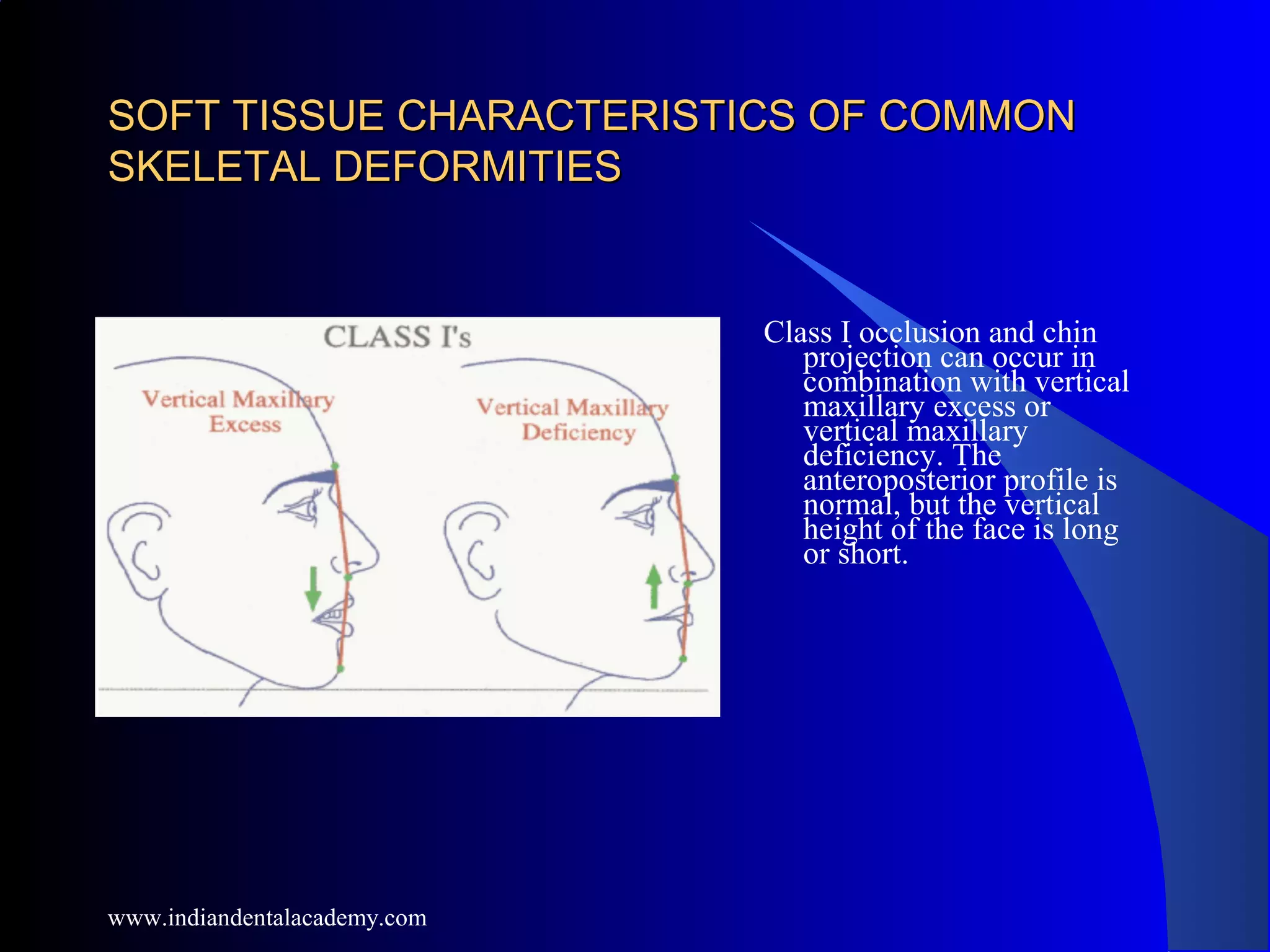 SOFT TISSUE CHARACTERISTICS OF COMMONSOFT TISSUE CHARACTERISTICS OF COMMON
SKELETAL DEFORMITIESSKELETAL DEFORMITIES
Class I occlusion and chin
projection can occur in
combination with vertical
maxillary excess or
vertical maxillary
deficiency. The
anteroposterior profile is
normal, but the vertical
height of the face is long
or short.
www.indiandentalacademy.com
 
