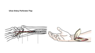 Ulnar Artery Perforator Flap
 