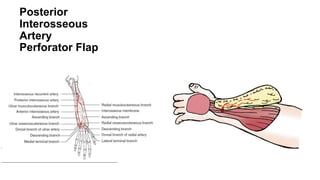 Posterior
Interosseous
Artery
Perforator Flap
 