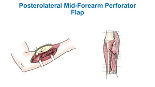 Posterolateral Mid-Forearm Perforator
Flap
 